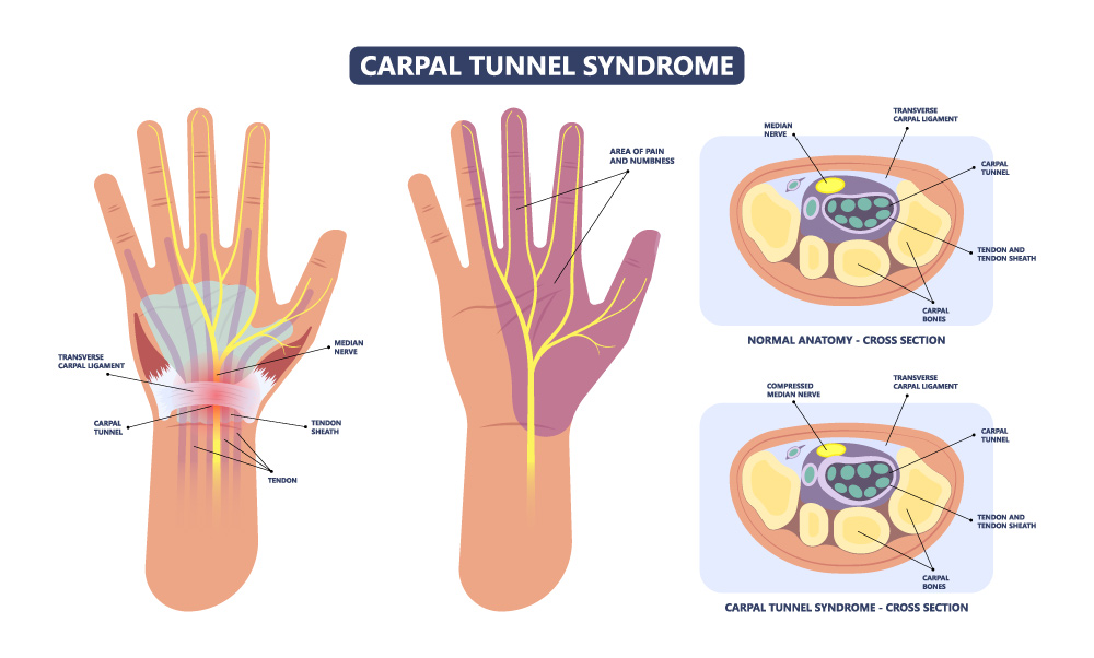 carpal tunnel symptoms, hand numbness, early signs of carpal tunnel